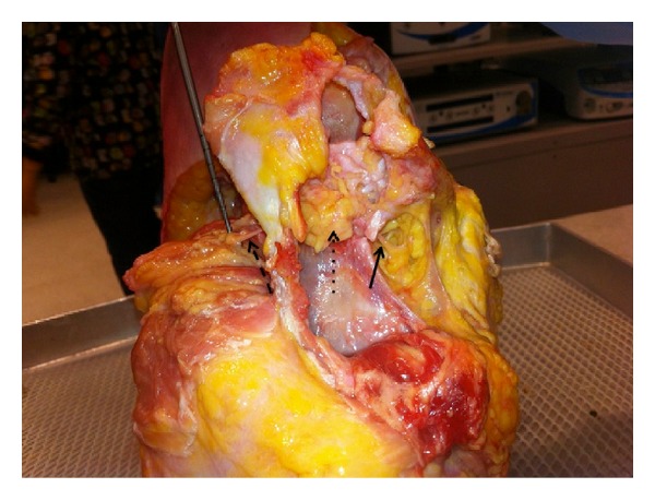 Scapulothoracic anatomy and snapping scapula syndrome.