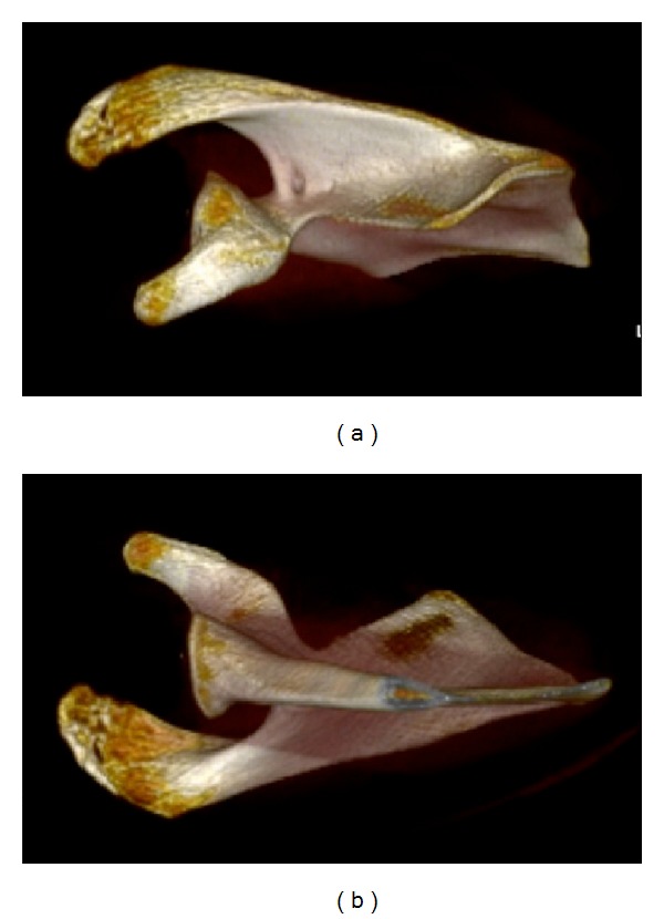 Scapulothoracic anatomy and snapping scapula syndrome.
