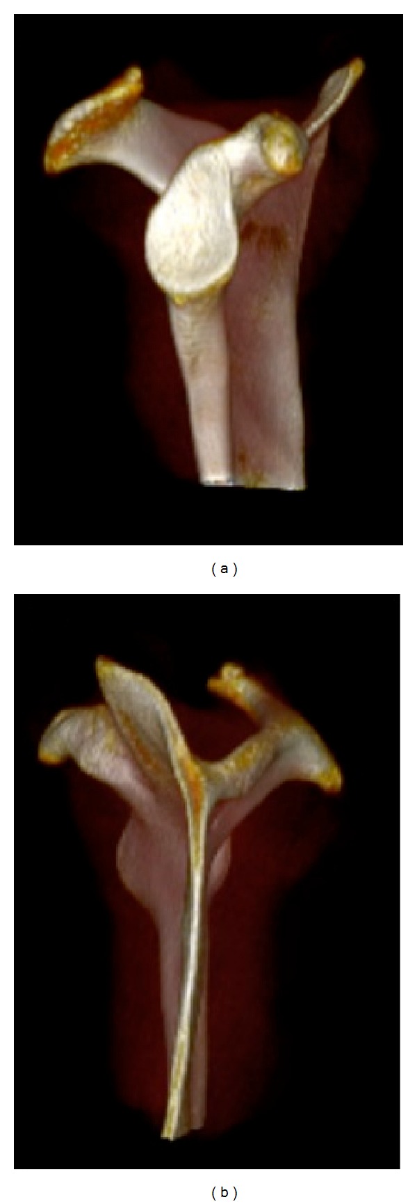 Scapulothoracic anatomy and snapping scapula syndrome.