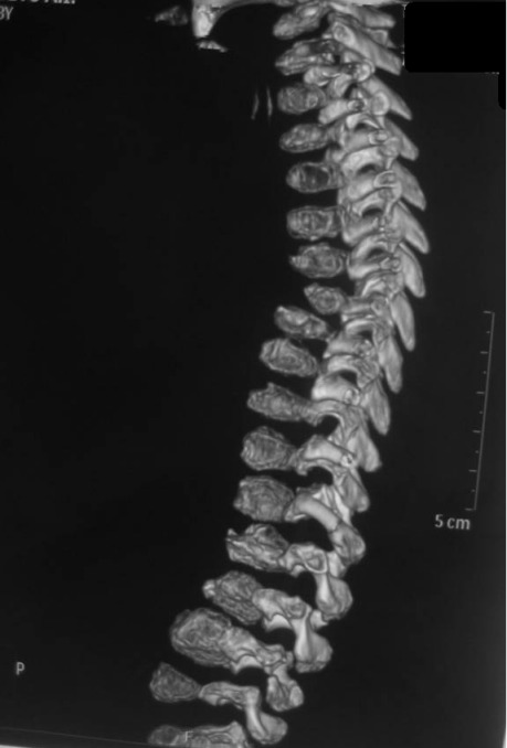 Spinal and extraspinal deformities in a patient with dysspondyloenchondromatosis.