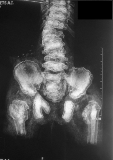 Spinal and extraspinal deformities in a patient with dysspondyloenchondromatosis.