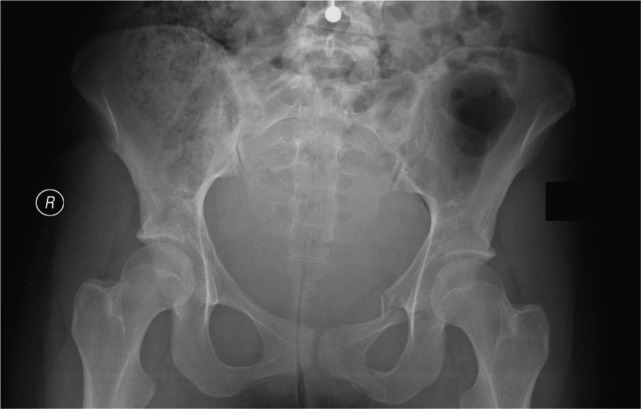Identification of a novel heterozygous mutation in exon 50 of the COL1A1 gene causing osteogenesis imperfecta.