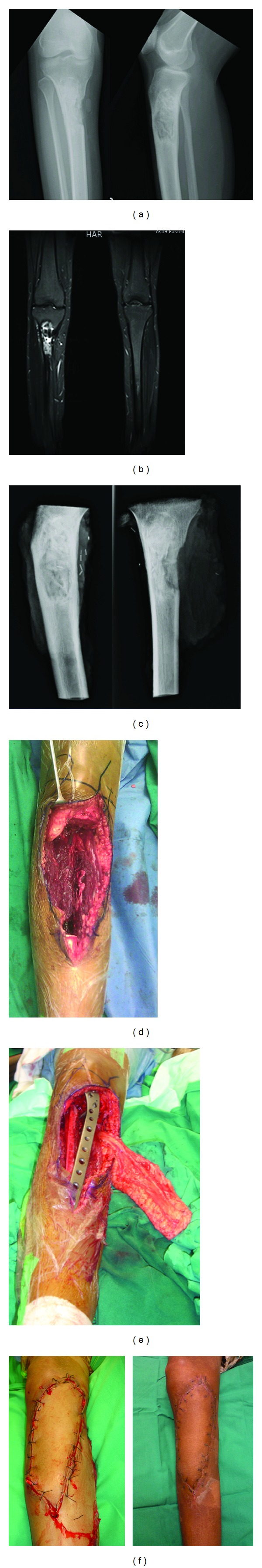 Complex biological reconstruction after wide excision of osteogenic sarcoma in lower extremities.
