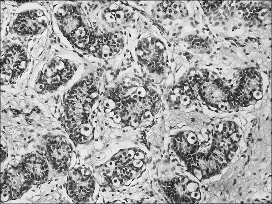 Compound Heterozygous Mutations in the SRD5A2 Gene Exon 4 in a Male Pseudohermaphrodite Patient of Chinese Origin