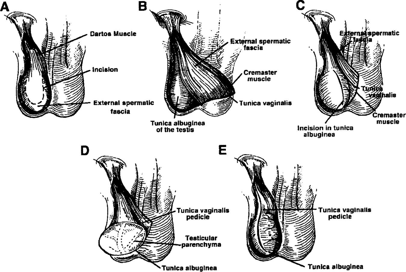 Autologous Tunica Vaginalis and Subcapsular Orchiectomy: A Hormonal Therapy for Prostate Cancer