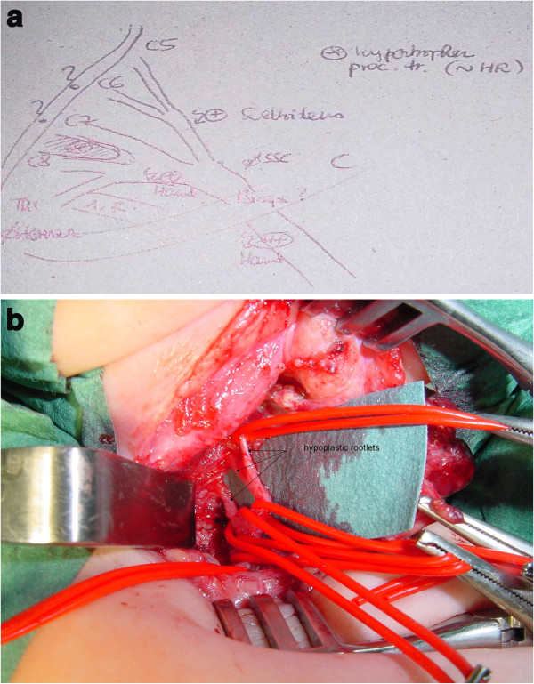 Arguments for a neuroorthopaedic strategy in upper limb arthrogryposis.