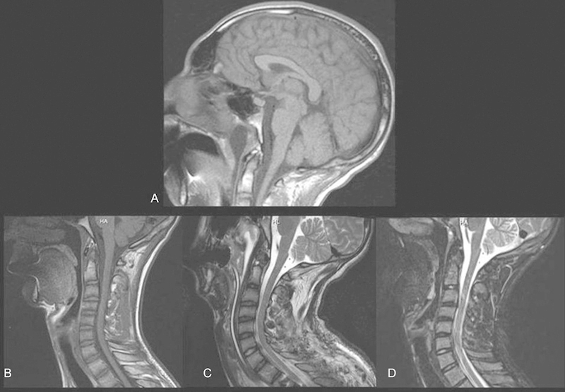 Occam paradox? A variation of tapia syndrome and an unreported complication of guidewire-assisted pedicle screw insertion.