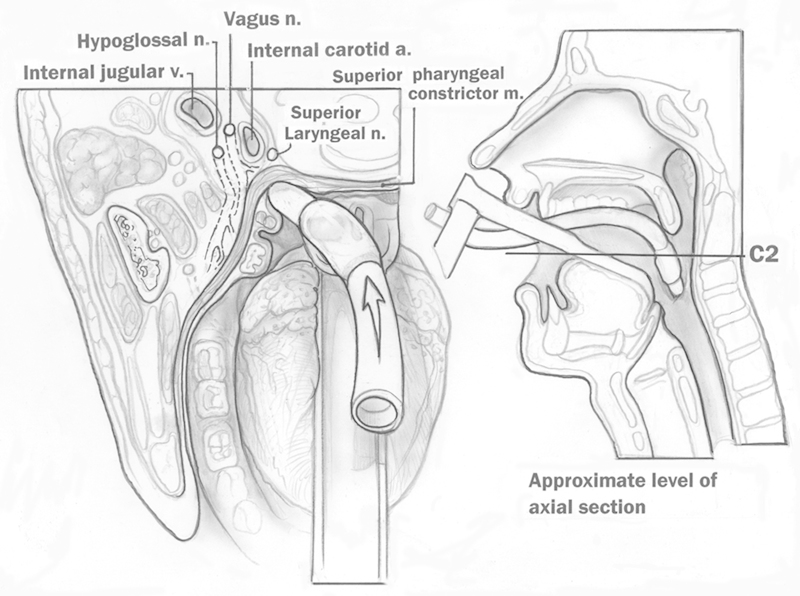 Occam paradox? A variation of tapia syndrome and an unreported complication of guidewire-assisted pedicle screw insertion.