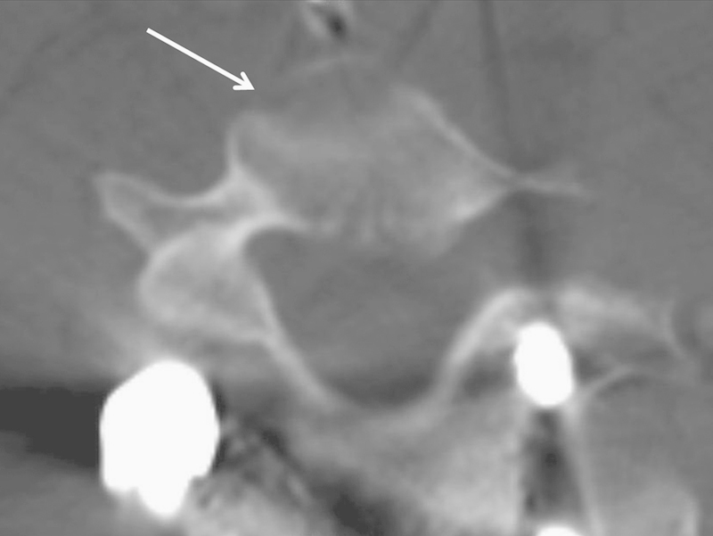 Occam paradox? A variation of tapia syndrome and an unreported complication of guidewire-assisted pedicle screw insertion.
