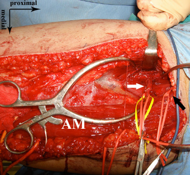 Free functional muscle transplantation of an anomalous femoral adductor with a very large muscle belly: a case report.