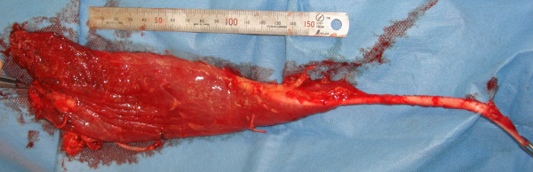 Free functional muscle transplantation of an anomalous femoral adductor with a very large muscle belly: a case report.