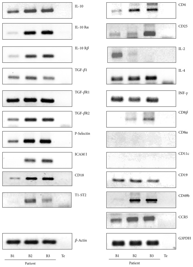 Overexpression of Regulatory T Cells Type 1 (Tr1) Specific Markers in a Patient with HCV-Induced Hepatocellular Carcinoma.