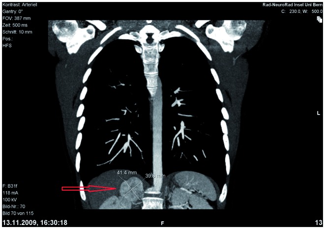 Hypertension, sweating and palpitation in a psychotic patient - don't miss the somatic cause.