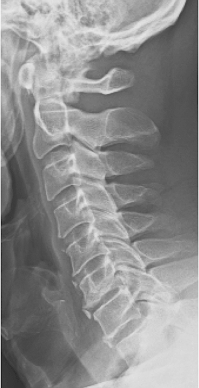 Comparative effectiveness of different types of cervical laminoplasty.