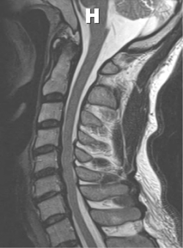 Comparative effectiveness of different types of cervical laminoplasty.