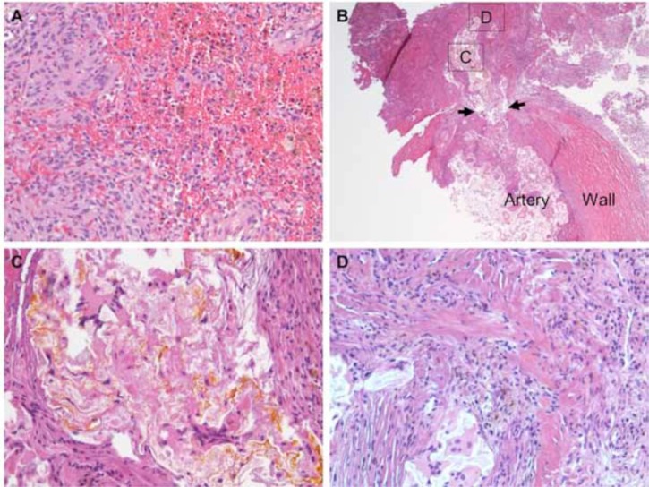 Case Report: Meningioma with Intra-tumoural Haemorrhage Secondary to Ruptured Distal Anterior Cerebral Artery Aneurysm.