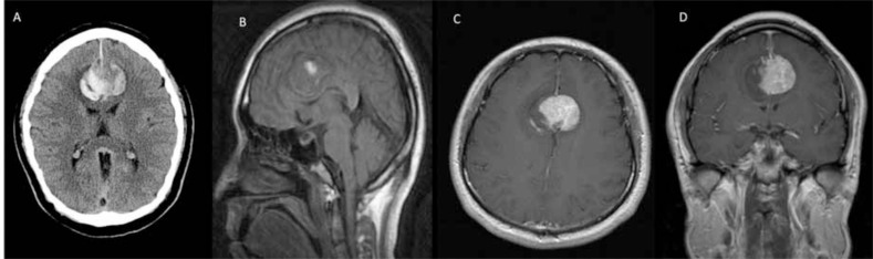 Case Report: Meningioma with Intra-tumoural Haemorrhage Secondary to Ruptured Distal Anterior Cerebral Artery Aneurysm.