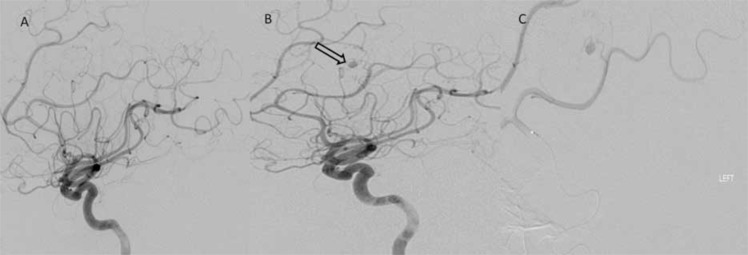 Case Report: Meningioma with Intra-tumoural Haemorrhage Secondary to Ruptured Distal Anterior Cerebral Artery Aneurysm.