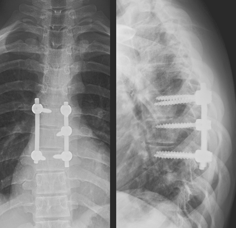 Periaortic pedicle screw removal with endovascular control of the aorta and intraoperative aortography: a case report and review of the literature.