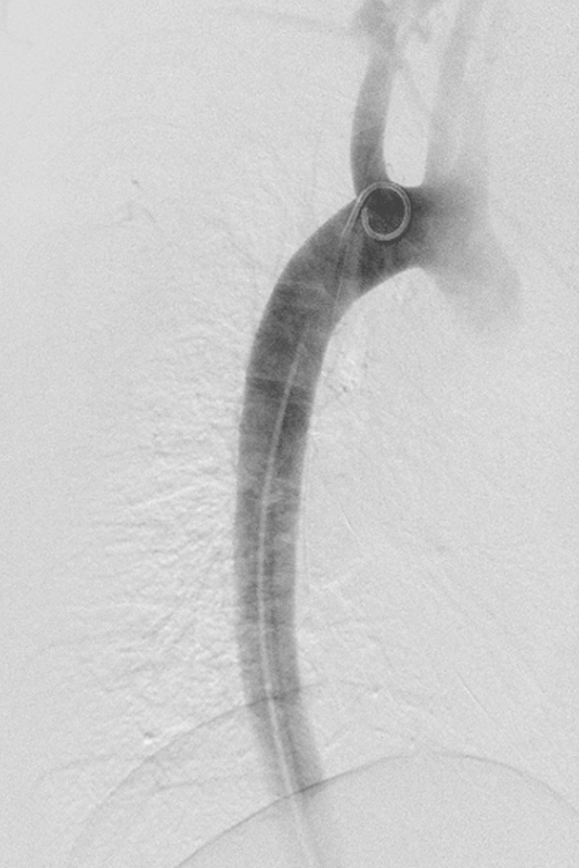 Periaortic pedicle screw removal with endovascular control of the aorta and intraoperative aortography: a case report and review of the literature.