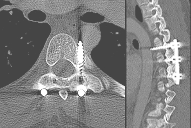 Periaortic pedicle screw removal with endovascular control of the aorta and intraoperative aortography: a case report and review of the literature.