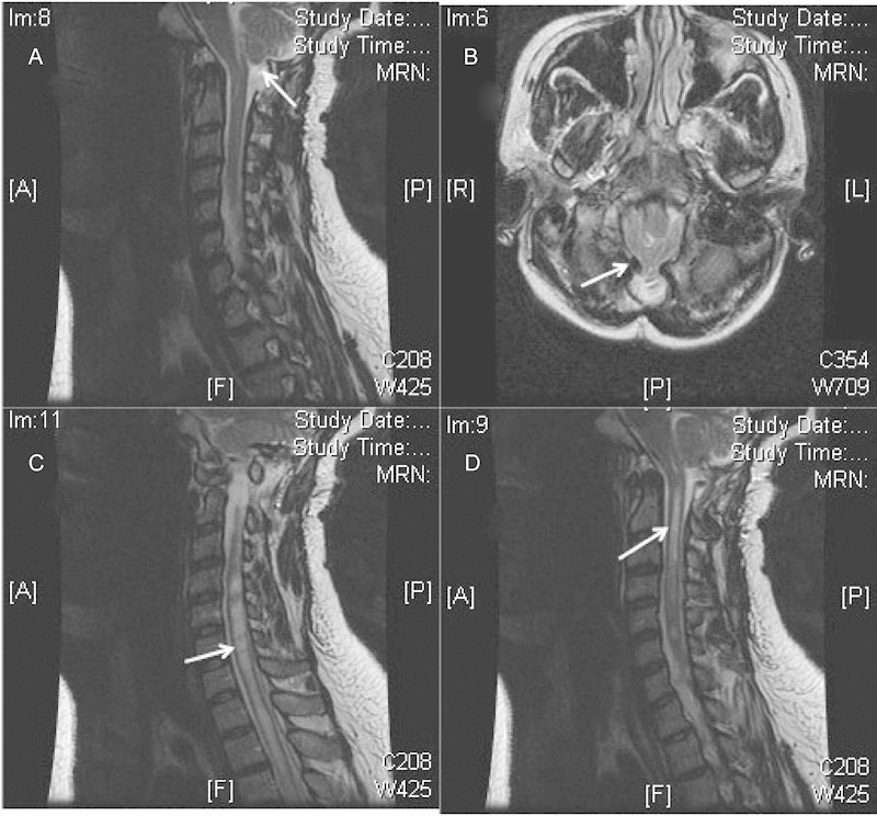 Persistent/Recurrent syringomyelia after Chiari decompression-natural history and management strategies: a systematic review.