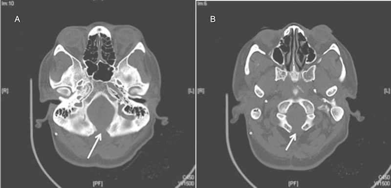 Persistent/Recurrent syringomyelia after Chiari decompression-natural history and management strategies: a systematic review.