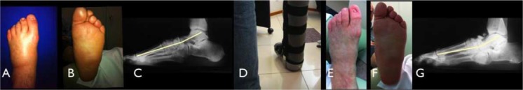 Radiographic and functional results in the treatment of early stages of Charcot neuroarthropathy with a walker boot and immediate weight bearing.