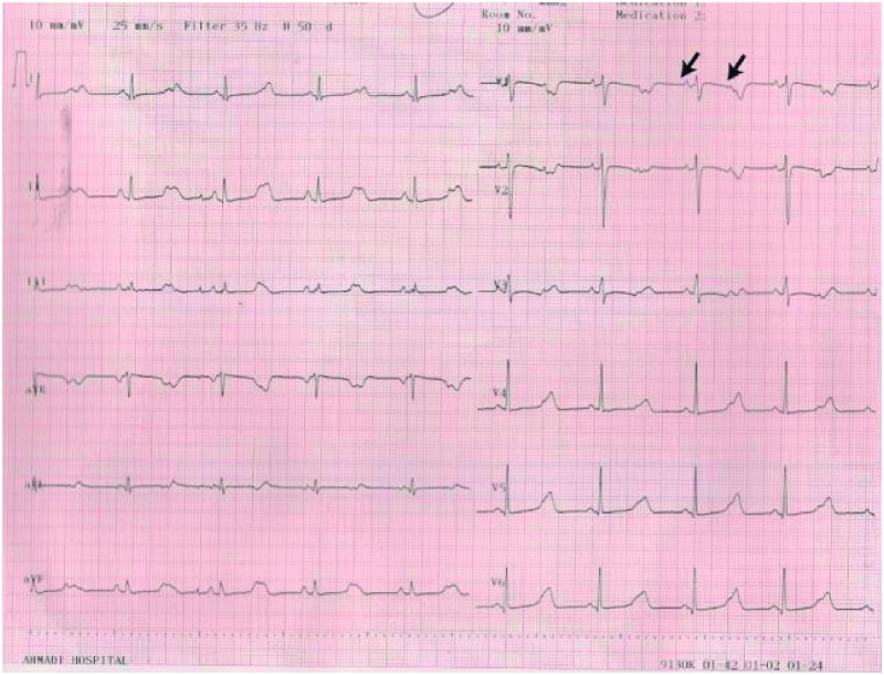 Beyond a prolonged QT interval.