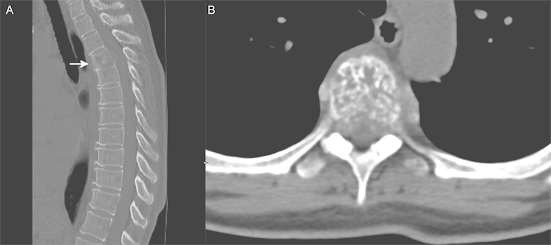 Desmoid Tumor Formation following Posterior Spinal Instrumentation Placement.