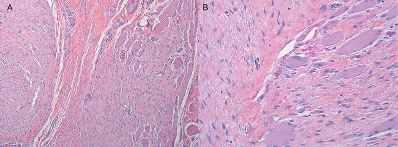 Desmoid Tumor Formation following Posterior Spinal Instrumentation Placement.