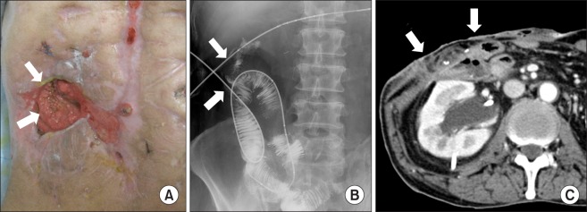 Abdominal wall defect with large duodenal disruption treated by a free tissue flap with a help of temporary expandable metallic stent.