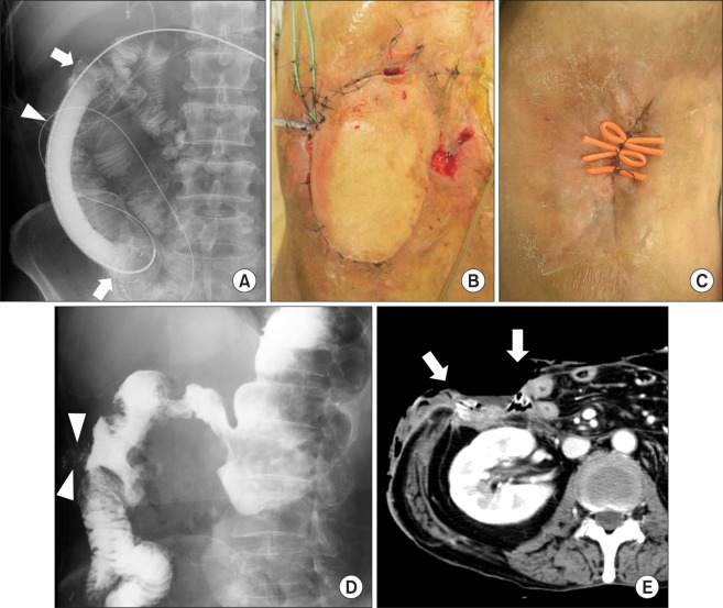 Abdominal wall defect with large duodenal disruption treated by a free tissue flap with a help of temporary expandable metallic stent.