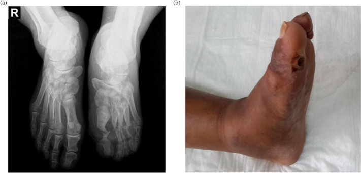 Osteomyelitis or Charcot neuro-osteoarthropathy? Differentiating these disorders in diabetic patients with a foot problem.