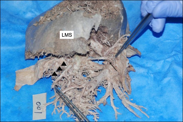 Variation or newly identified glissonian pedicles between the lateral and medial sections of the liver, using cadaver dissection.