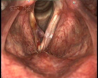 Diagnostic and therapeutic pitfalls in benign vocal fold diseases.