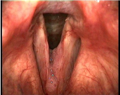 Diagnostic and therapeutic pitfalls in benign vocal fold diseases.