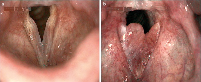Diagnostic and therapeutic pitfalls in benign vocal fold diseases.