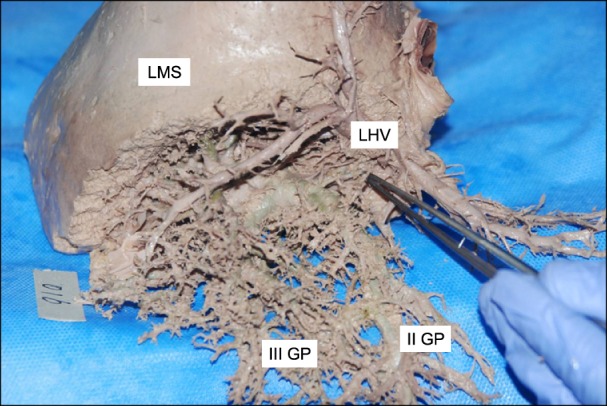 Variation or newly identified glissonian pedicles between the lateral and medial sections of the liver, using cadaver dissection.