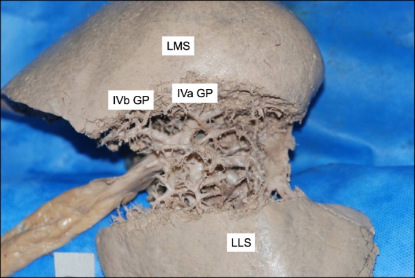 Variation or newly identified glissonian pedicles between the lateral and medial sections of the liver, using cadaver dissection.