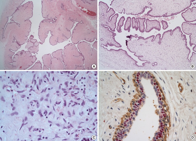 Cystic benign phyllodes tumor in the inguinal region.