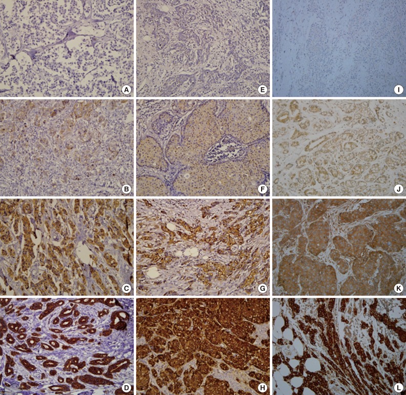 Microtubule-Associated Protein Tau, α-Tubulin and βIII-Tubulin Expression in Breast Cancer.