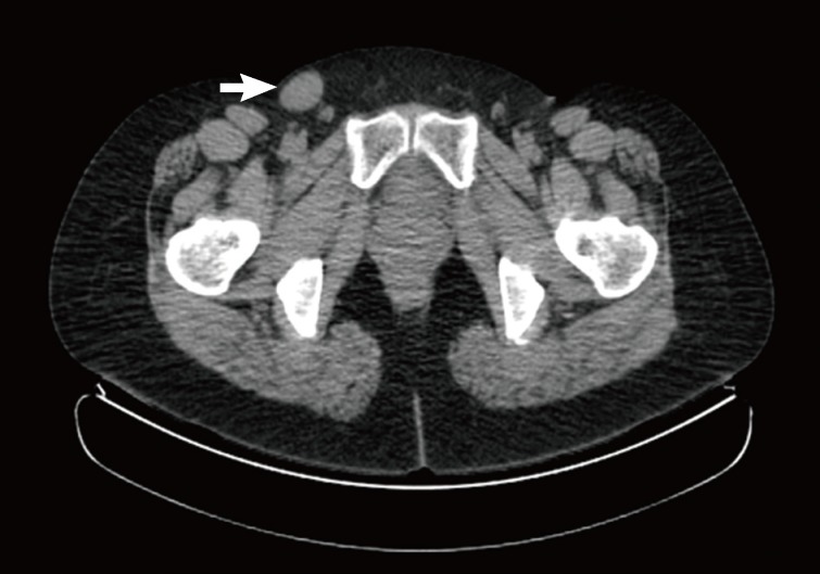 Cystic benign phyllodes tumor in the inguinal region.