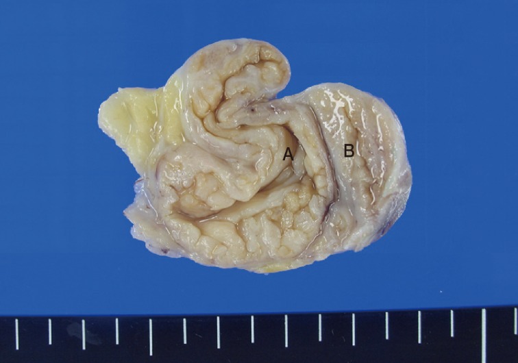 Cystic benign phyllodes tumor in the inguinal region.