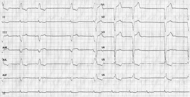 Implantation of transvenous permanent pacemaker in a patient with persistent left superior vena cava and absent right superior vena cava.