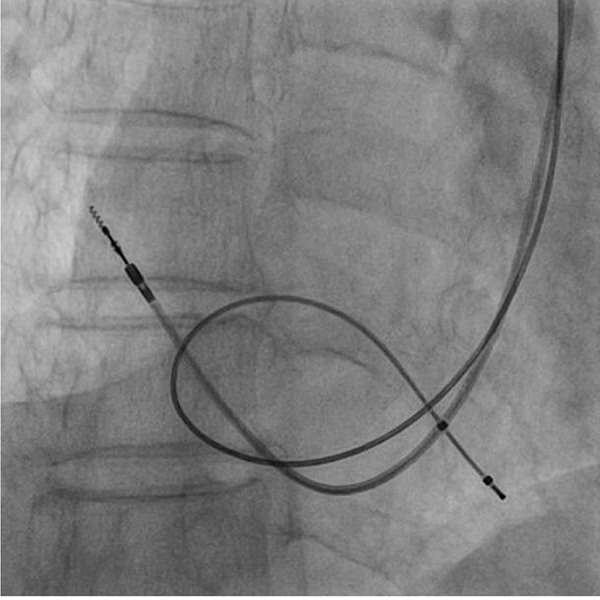 Implantation of transvenous permanent pacemaker in a patient with persistent left superior vena cava and absent right superior vena cava.