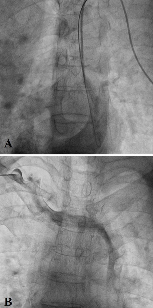 Implantation of transvenous permanent pacemaker in a patient with persistent left superior vena cava and absent right superior vena cava.