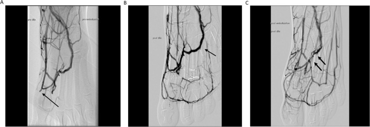 Early results from an angiosome-directed open surgical technique for venous arterialization in patients with critical lower limb ischemia.