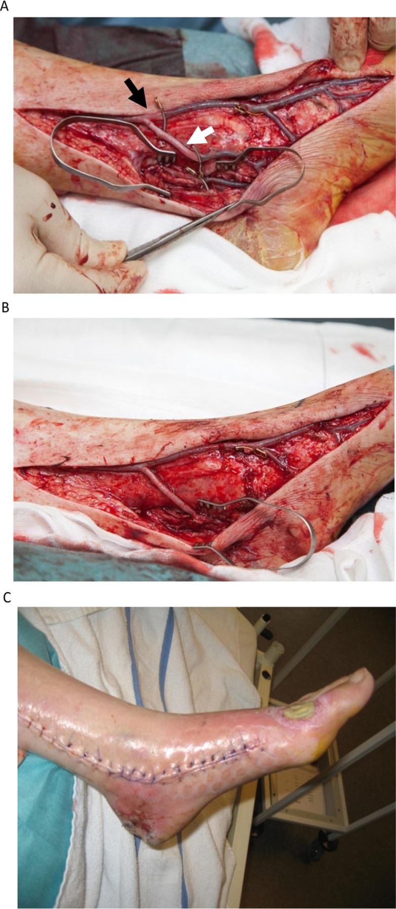 Early results from an angiosome-directed open surgical technique for venous arterialization in patients with critical lower limb ischemia.