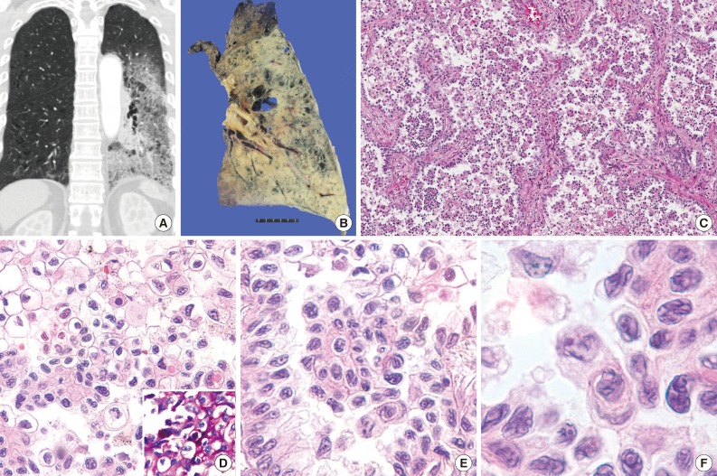 Micropapillary mucinous adenocarcinoma of the lung: a brief case report.